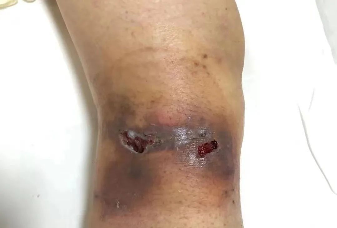 打針皮血狗咬破點需要打針嗎_狗咬破了皮有一點血需要打針嗎_打針皮血狗咬破點需要打疫苗嗎